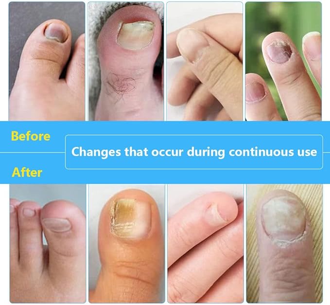 Láser Portátil Antihongos para Uñas – Tratamiento Seguro y Efectivo