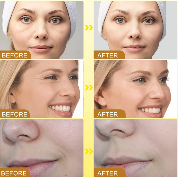 Botox Bee Venom rejuvenece tu piel sin agujas