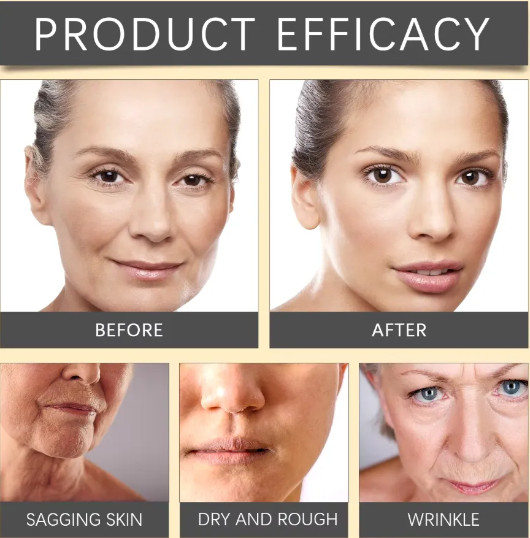Botox Bee Venom rejuvenece tu piel sin agujas